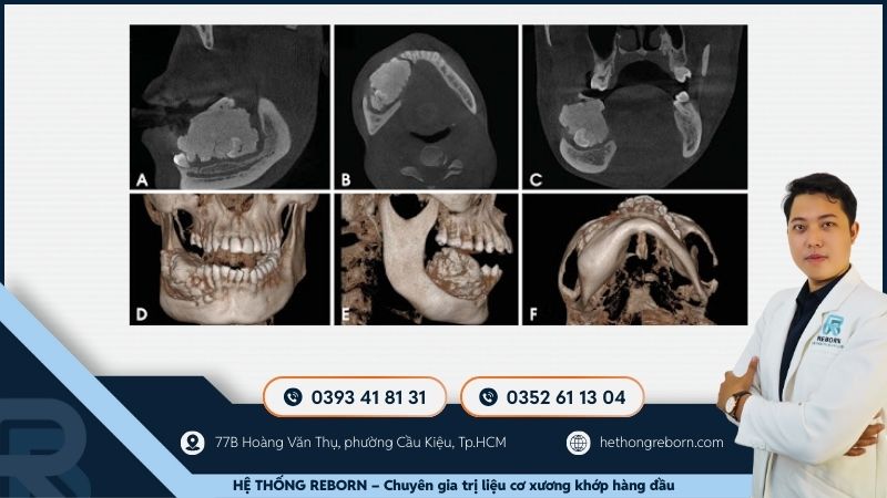 Chẩn đoán lệch xương quai hàm: khám lâm sàng, chụp phim X-quang, và CT Cone Beam 3D hiện đại