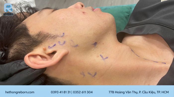 nguyên nhân gây lệch mặt