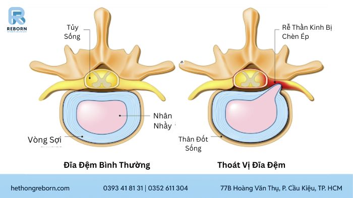 Rách Bao Xơ Đĩa Đệm