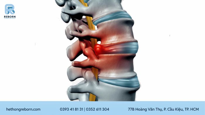 Thoát Vị Đĩa Đệm